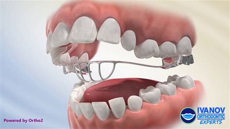 The Magical Dental Appliance: Your Key to a Radiant Smile